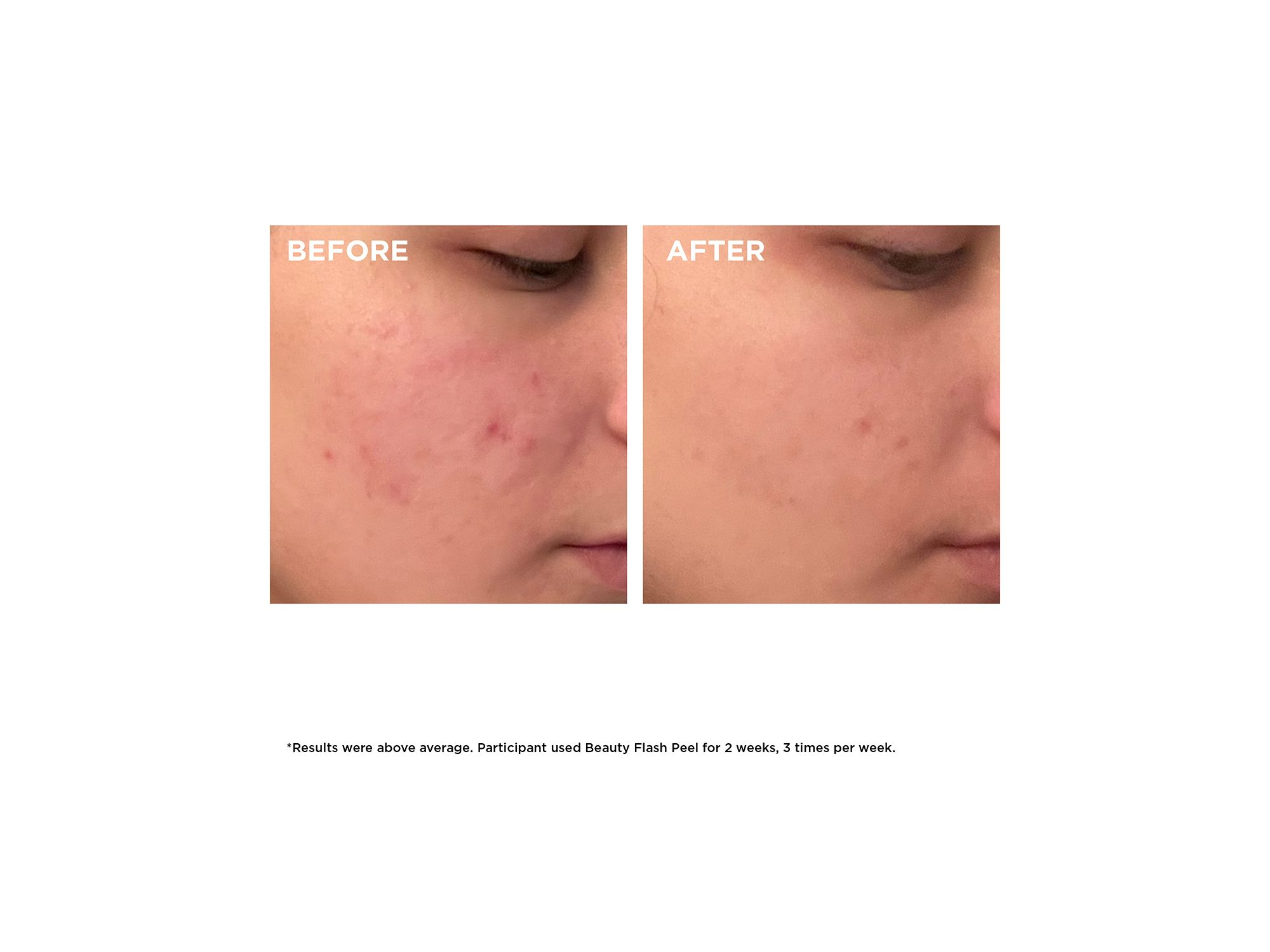 Beauty Flash Peel with BHA & AHA 1.7 oz. — Image 5