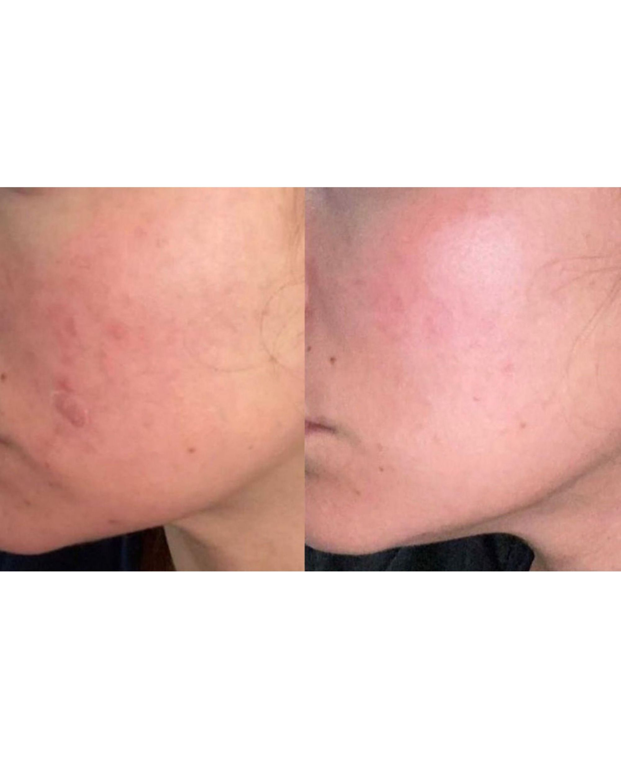 Acne Control Serum - 1.1.oz — Image 4