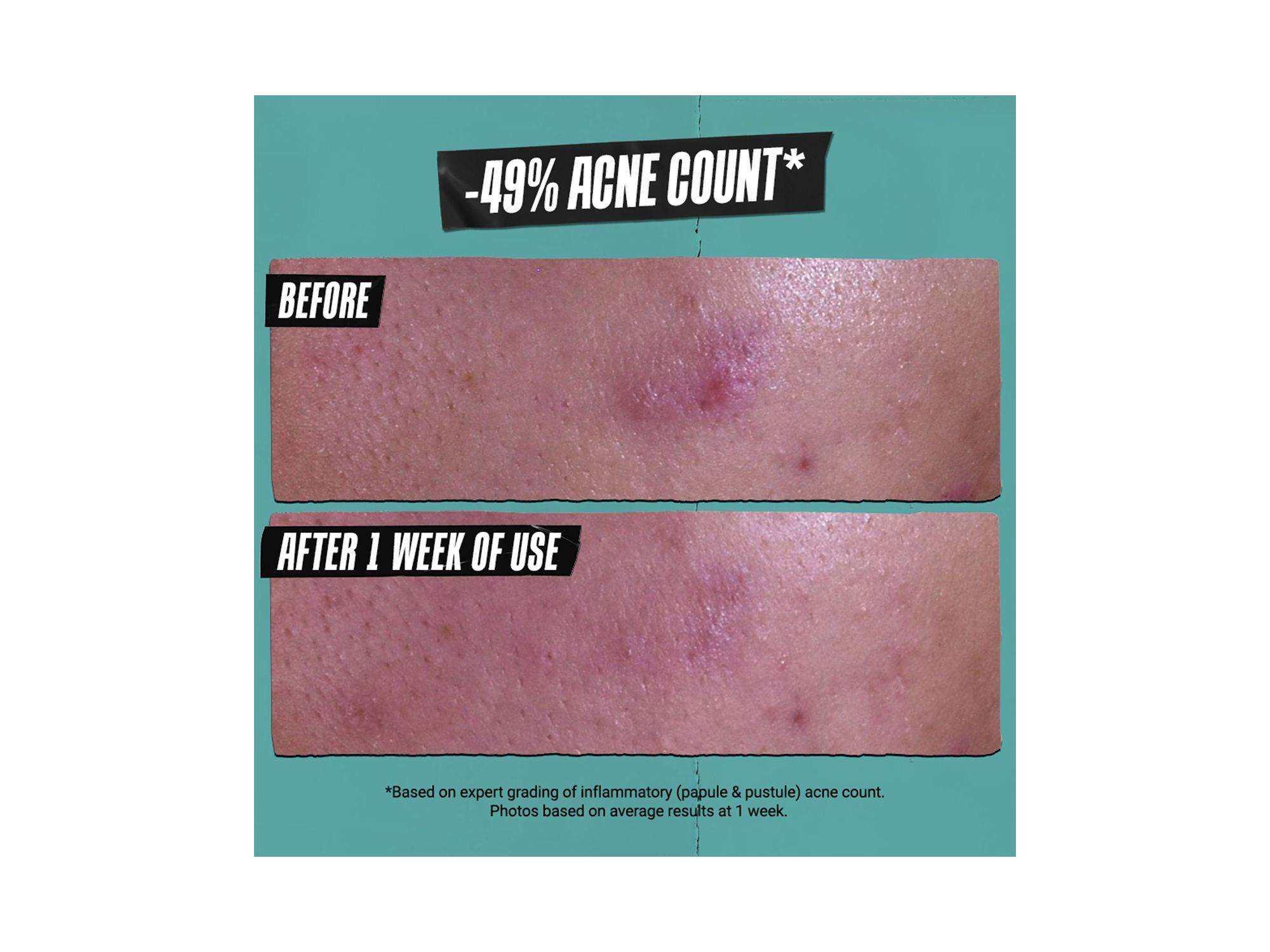 Gently Effective Acne Treating Cleansing Paste 4.2 oz. — Image 3
