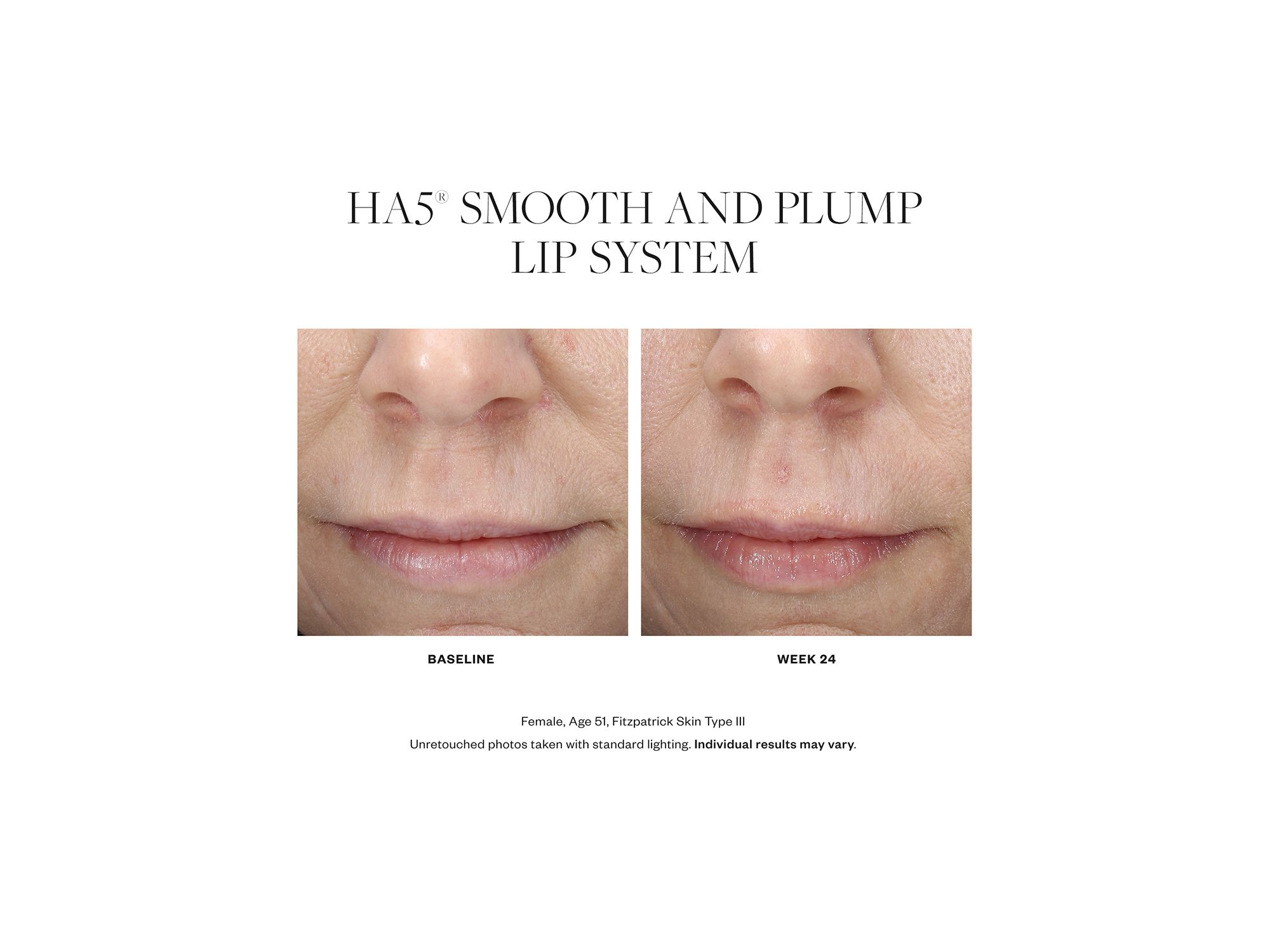 HA5 Smooth & Plump Lip System — Image 3