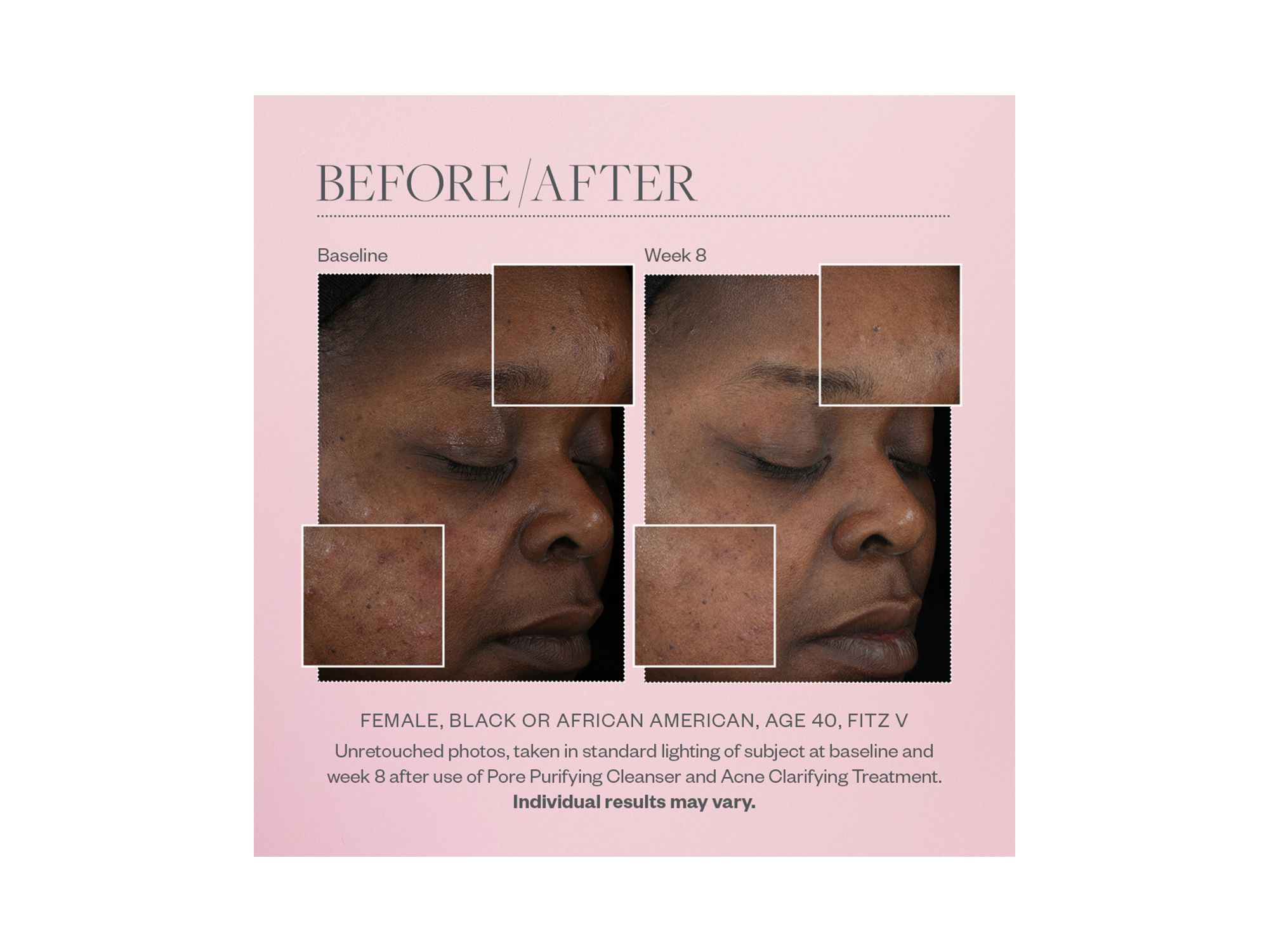Acne Clarifying Treatment 2 oz. — Image 4
