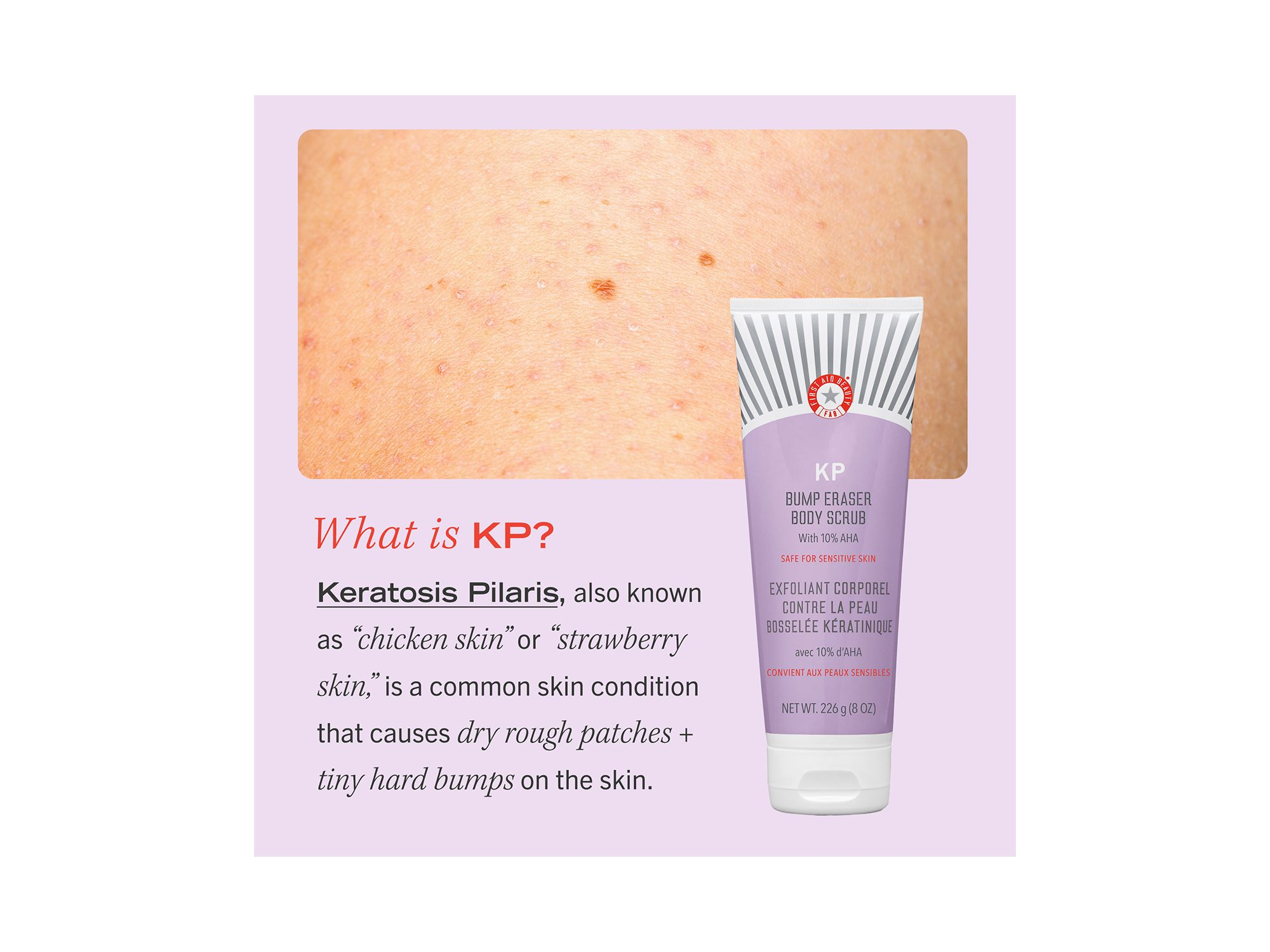 KP Bump Eraser Body Scrub with 10% AHA - Body Exfoliant for Keratosis Pilaris — Image 5